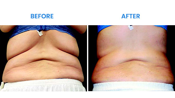Before and After Before and After