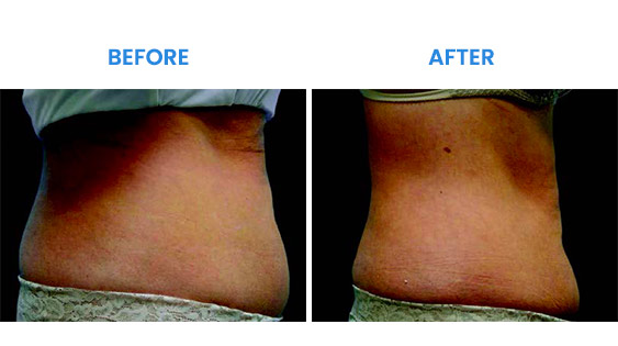 Before and After Before and After
