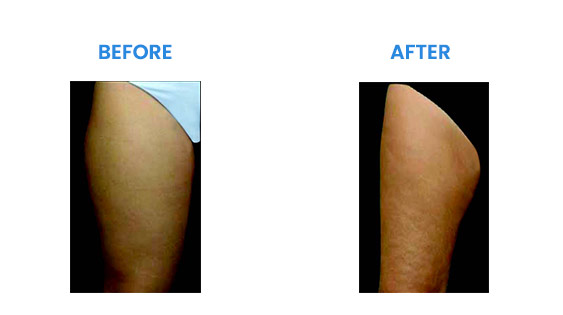 Before and After Before and After