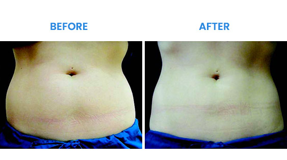 Before and After Before and After